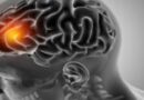 Estudo acende alerta para meningite: queda nas mortes é lenta e pode comprometer meta da OMS